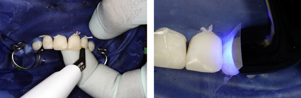 Fig.12 : Photopolymérisation des couches à l’aide d’une lampe S.P.E.C 3 LED pendant 15s. Fig.11 : La teinte universelle A3/D3 est exclusivement utilisée pour la restauration. 