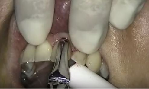 Extraction implantation et provisoire immédiates