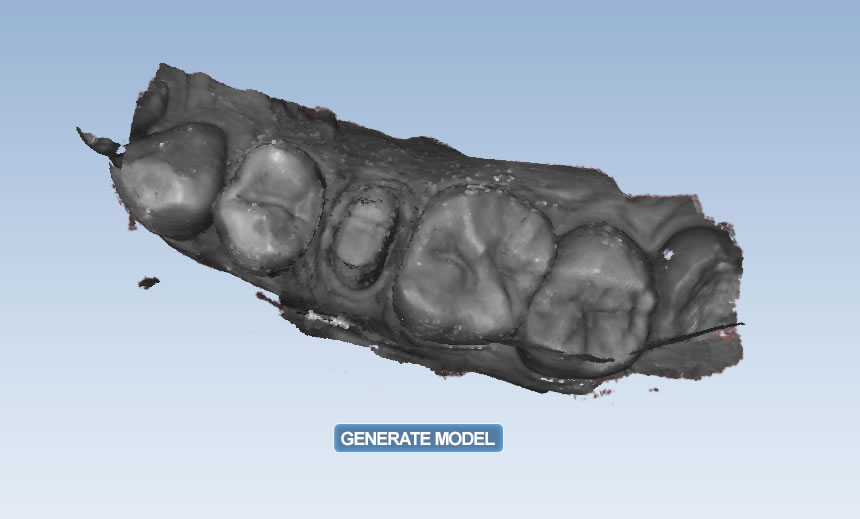 Empreinte optique avant affinage (Planmeca Planscan)