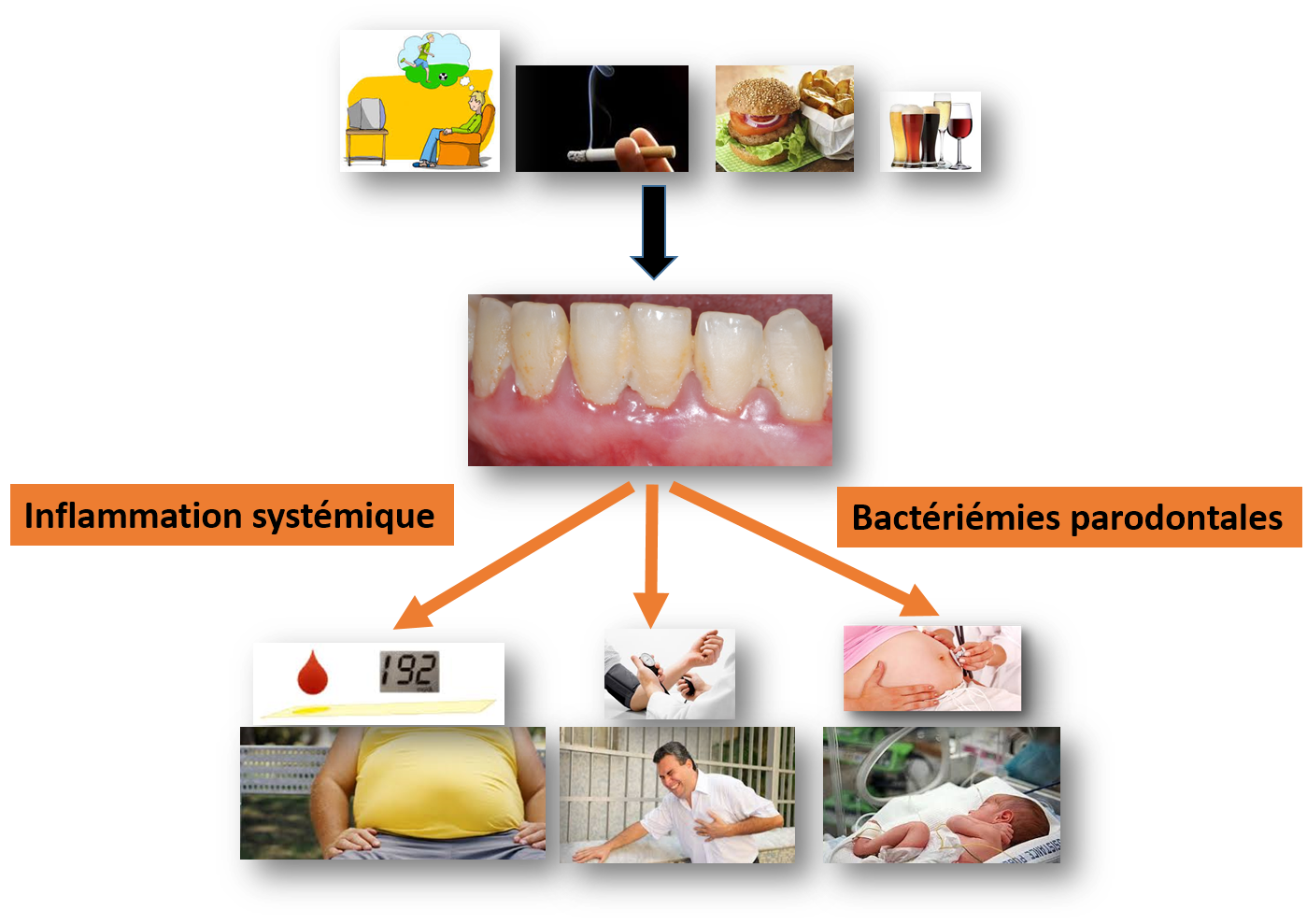 Figure 2 : Les maladies parodontales et les autres maladies inflammatoires sont liées par des mécanismes biologiques : les bactériémies parodontales et l’inflammation systémique.