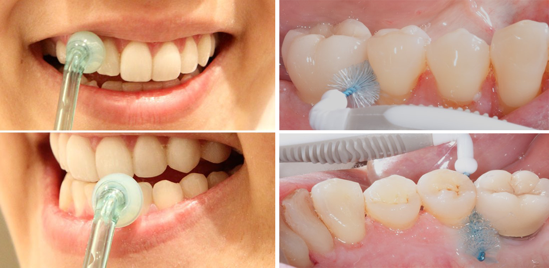 Figure 1 : Le contrôle de plaque interdentaire fait partie du traitement des parodontites (photos de droite) et participe à leur prévention primaire (chez les patients au parodonte sain, photos de gauche) et secondaire (chez les patients atteints de gingivite)