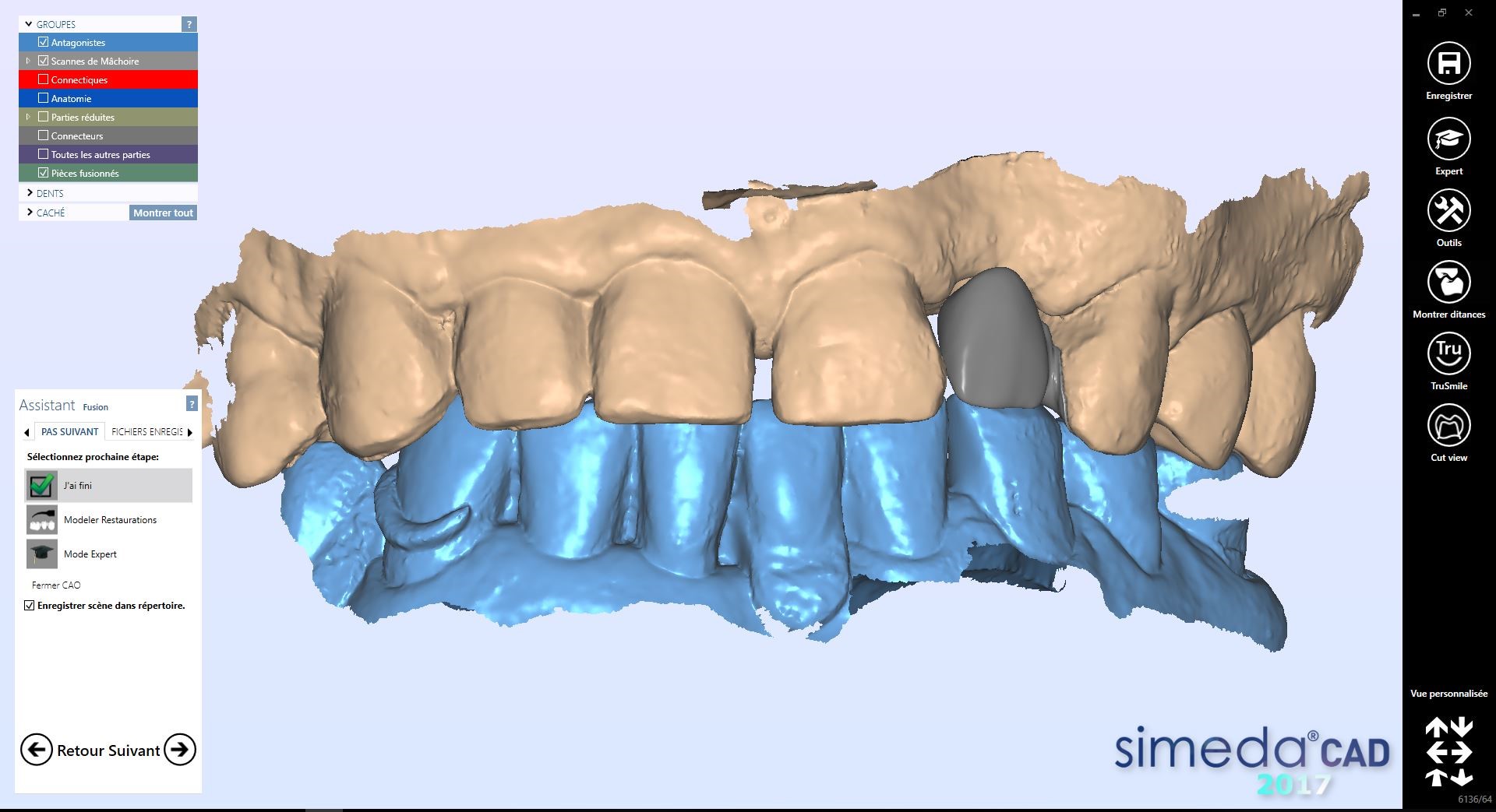 Armature en vue vestibulaire (source Digital Labs)