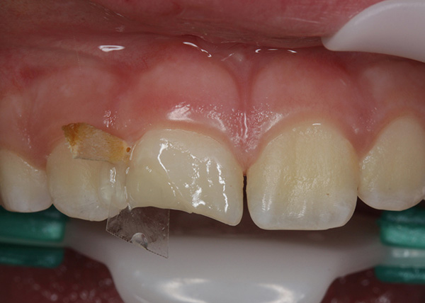 Obturation dentaire : matériaux, étapes du traitement, ce qu'il vous faut  savoir
