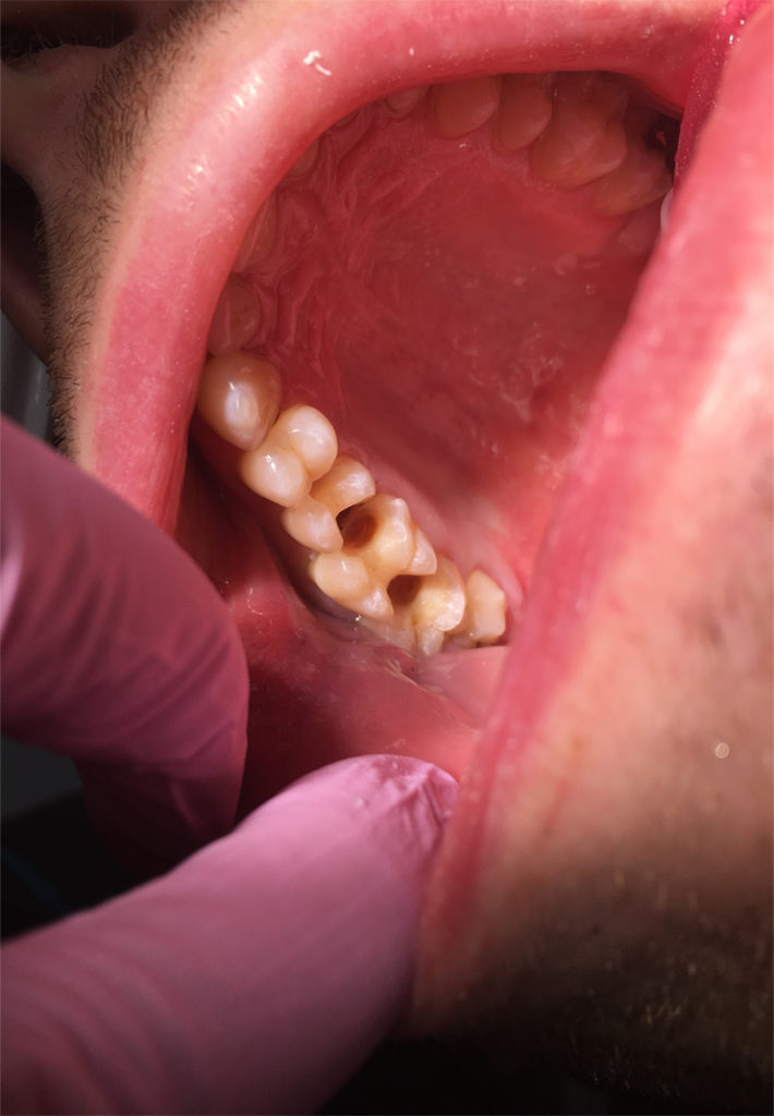 Lentilles de vue intrabuccales dentaires Réflecteur de soins  bucco-dentaires Miroir Rhodium Occlusal Glas