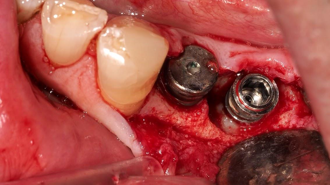 cas clinique - Gestion Parodontale et Prothétique d’une Péri-Implantite chez un patient à haut risque parodontal
