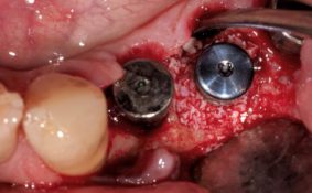 cas clinique - Gestion Parodontale et Prothétique d’une Péri-Implantite chez un patient à haut risque parodontal