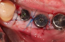 cas clinique - Gestion Parodontale et Prothétique d’une Péri-Implantitechez un patient à haut risque parodontal