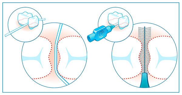 L'efficacité des brossettes interdentaires a été reconfirmée