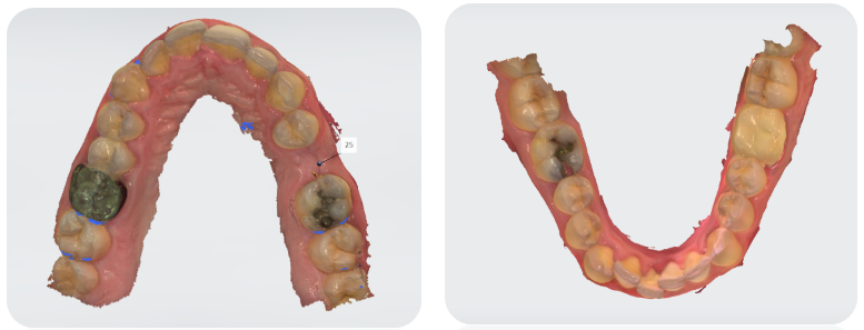 Figure 2 : Modèle numérique du patient après cicatrisation du site réalisé avec la caméra Trios 3 ® de 3shape
