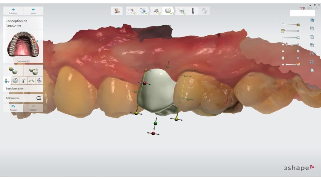 Figure 3 : Design de la future couronne prothétique de 25