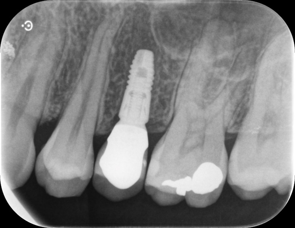 Figure 14 : Radio de contrôle de la prothèse sur implant