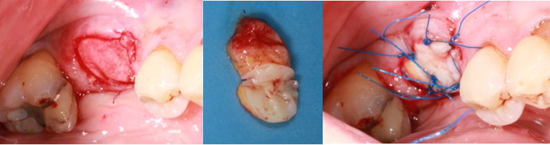 Fig 4 : Reconstruction des tissus durs avec une xenogreffe et membrane. Le site est refermé à l’aide d’une greffe epithélio-conjonctive avec languette conjonctive glissée sous la gencive vestibulaire.