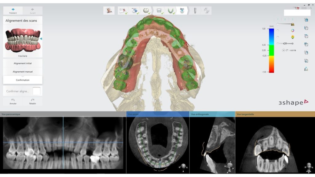 Figure 5 : Validation de la superposition entre modèle numérique et radiographie 3D avec le logiciel Implant Studio(r) de 3shape. Un code couleur permet de repérer immédiatement la précision de la superposition des deux fichiers.