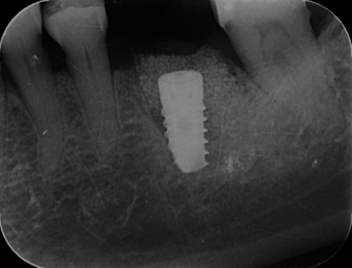 Fig 5 : Position finale de l’implant et reconstruction
