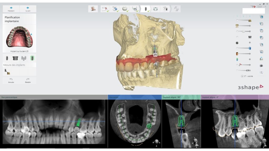 Figure 6 : Planification implantaire à partir du design prothétique et des éléments anatomiques radiographiques
