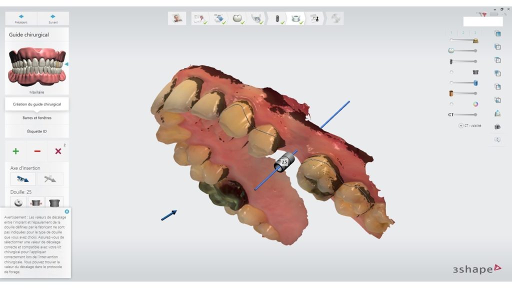 Figure 7 : En marron, les zones de contre-dépouilles nous aident au dessin de la périphérie du guide chirurgical. 