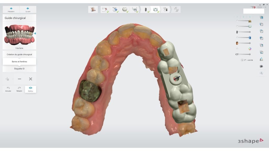 Figure 8 : Design du guide chirurgical avec Implant Studio(r) de 3shape
