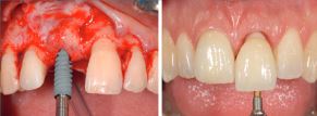 implant unitaire en secteur esthétique
