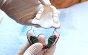 Vignette-Site-Tuto-Prothese-3-CRB