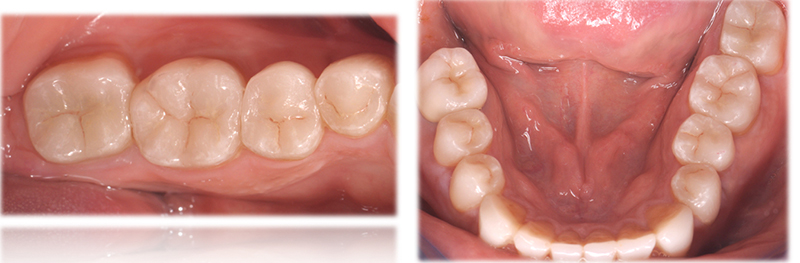 Réalisation prothétique : Laboratoire Esthetic Oral