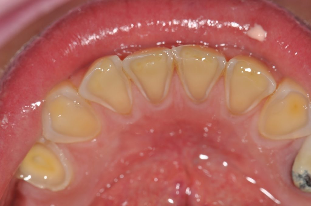 Jusqu'à 62% 1 ou 2 protège-dents pour la prévention de l'usure des dents