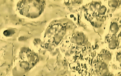 parodontites