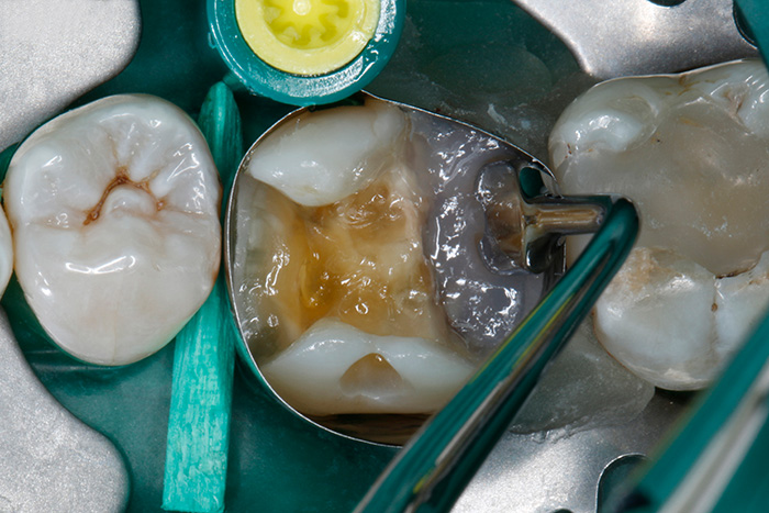 Reconstitution des cuspides dans la région molaire