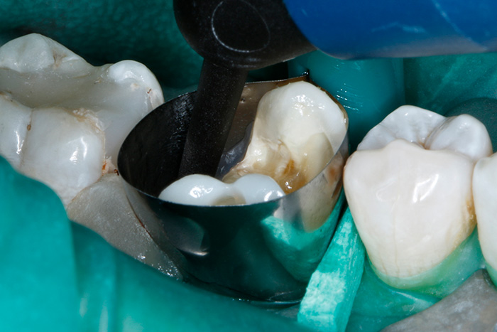 Reconstitution des cuspides dans la région molaire