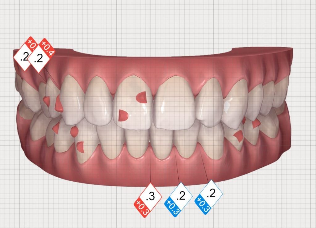 Second Clincheck