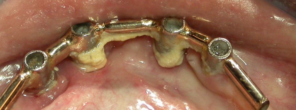 Fig. 1 : Les brossettes interdentaires doivent pouvoir accéder facilement entre 2 implants.