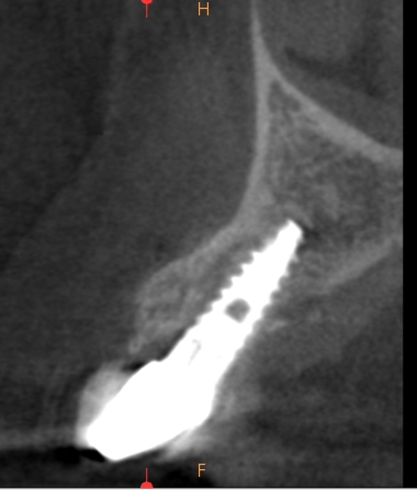 Résorption paroi palatine suite à extraction de la partie coronaire.