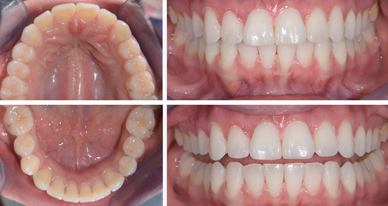 Dentition finalisée par Invisalign