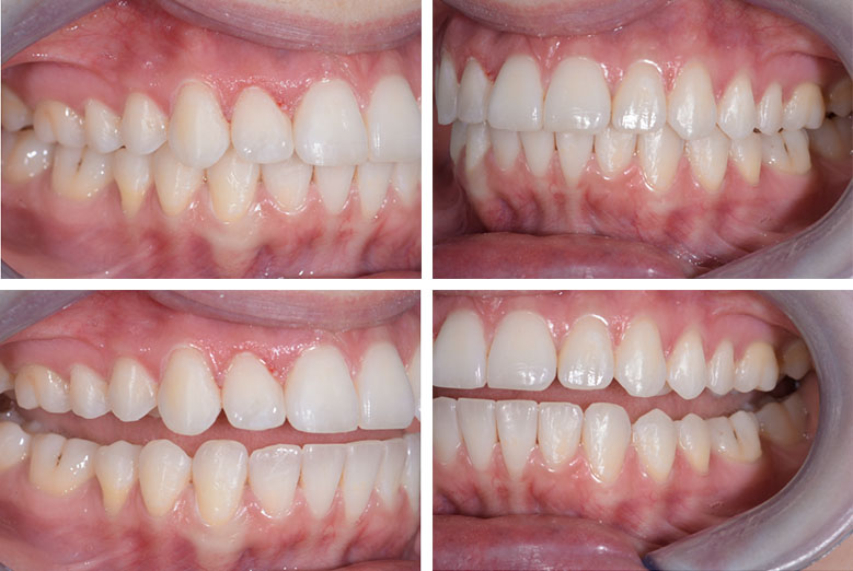 Dentition finalisée par Invisalign