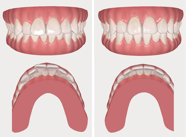 Montage photo Invisalign 1