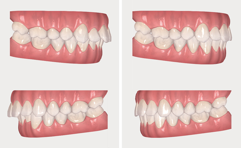 Montage Invisalign vue 2