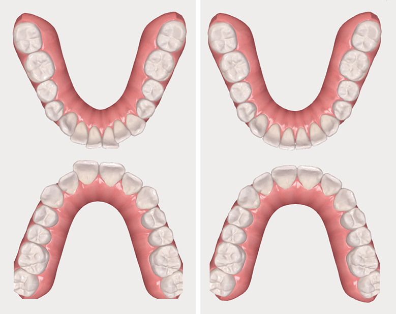 Montage Invisalign vue 3