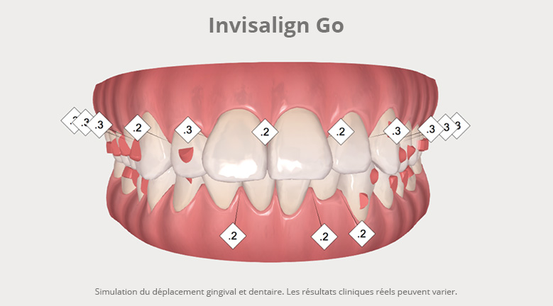 Invisalign Go