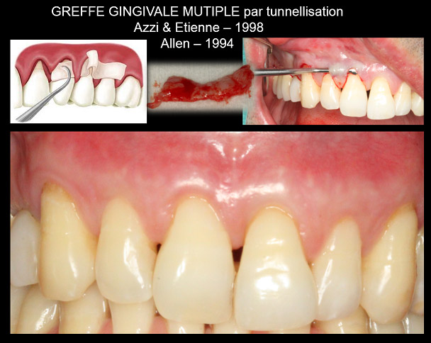 Greffe gingivale multiple