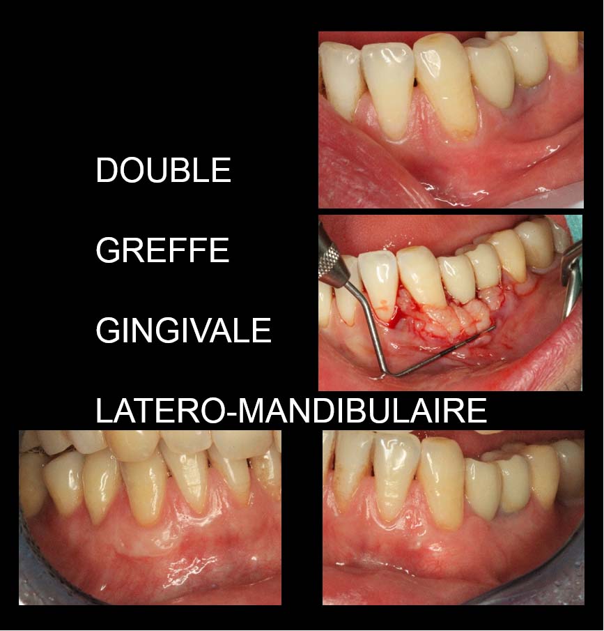 Double greffe gingivale latero-mandibulaire