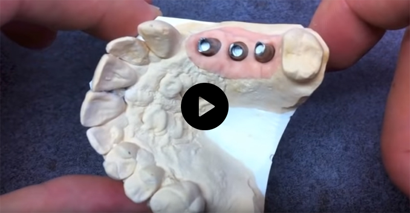 Video-scellement-prothese-implant