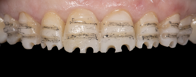 Dents alignées