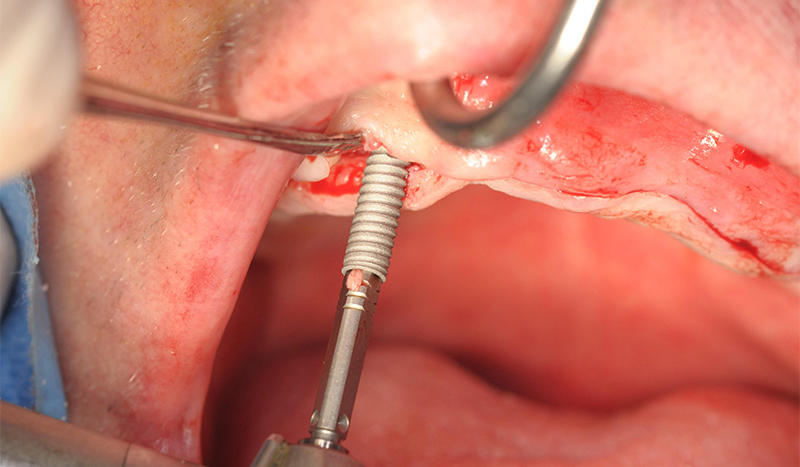 Fig-11-pose d’un implant