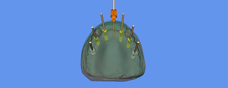 Fig-2-planification implantaire