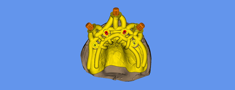 Fig-3-vue occlusale