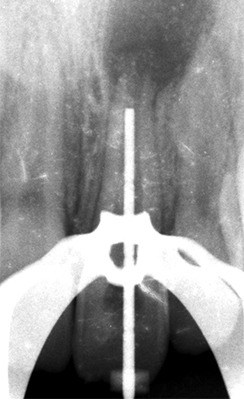 Radiographie de calibrage