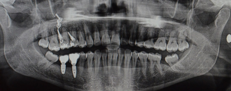 Radiographie-finale-23