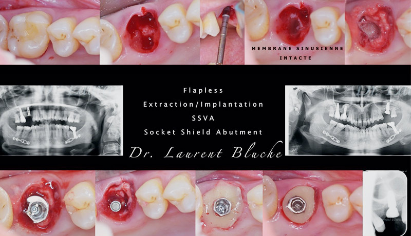 2-Chirurgie-post-extractionnelle-Laurent-Bluche