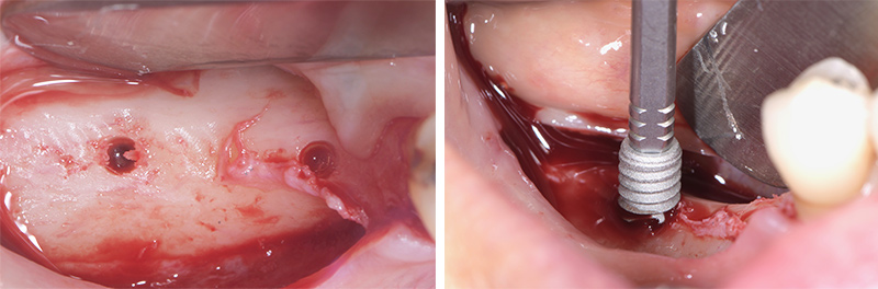 Forage et implant
