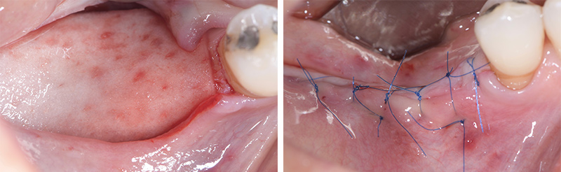 Suture-14