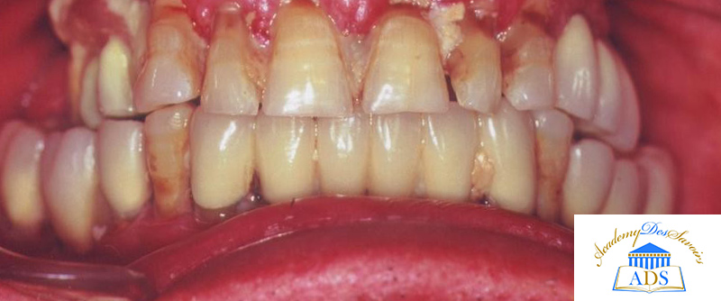 Figure-2-Atteinte parodontale généralisée